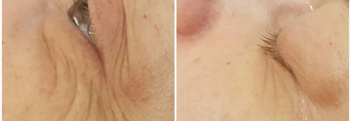 Trattamento viso professionale presso Beauty Zone centro estetico